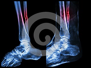 Left image : Fracture shaft of fibula (calf bone) , Right image : It was splinted with plaster cast