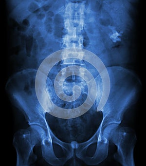 Left kidney stoneand bladder stone