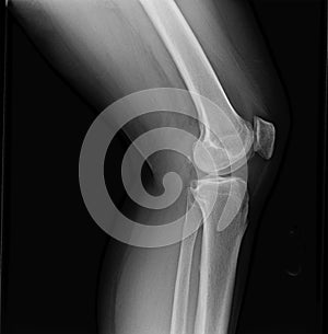 Left knee joint x-ray of mature female with osteoarthritis