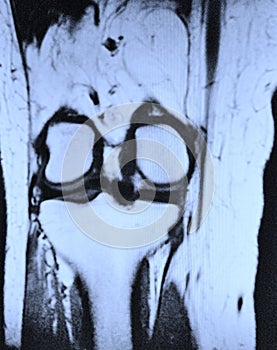 Left knee mri