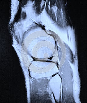 Left knee mri