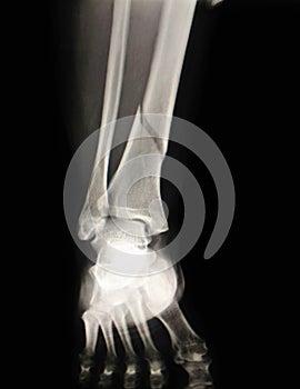 Left leg broken.Film x-ray left leg show tibai bone broken