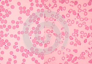 Left normal and right thalassemia blood smear.