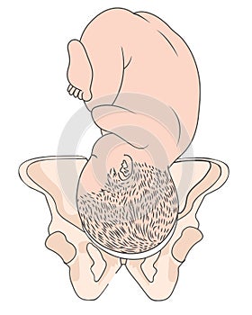 Left Occiput Anterior LOA Baby Fetal Position  ROA Right photo