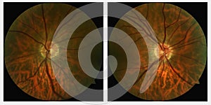 Left and right Eye scans