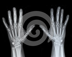 Left and Right Hand X-Ray