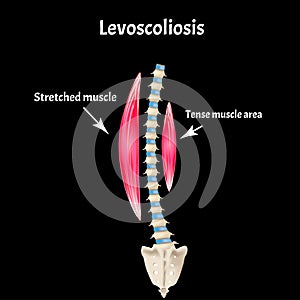 Left-sided scoliosis. Levoscoliosis. Muscles and spine. Spinal curvature in scoliosis. Infographics. Vector illustration
