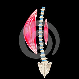 Left-sided scoliosis. Levoscoliosis. Muscles and spine. Spinal curvature in scoliosis. Infographics. Vector illustration