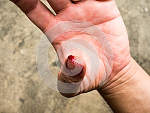 Left thumb The blood flow caused by the estimate should not be cautious in repairing the plumbing