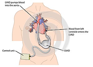 Left ventricular assist device (LVAD)