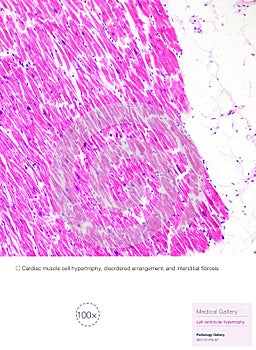 Left ventricular hypertrophy