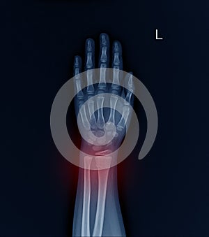 Left Wrist X-ray fracture raduis