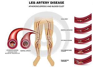 Leg artery disease, Atherosclerosis