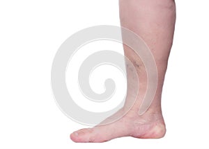 Leg of an elderly woman on a white background with varicose veins, close-up, isolate, phlebeurysm and thrombosis