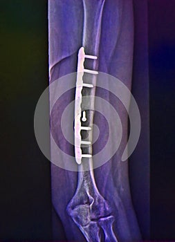 Leg fracture, x ray, surgery