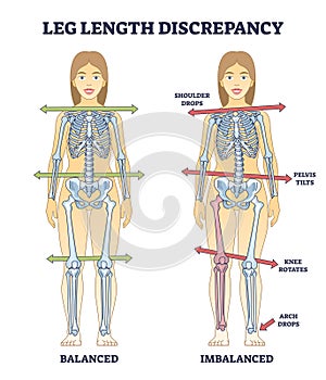 Leg length discrepancy condition with imbalanced skeleton outline diagram