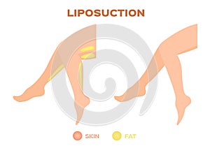 Leg liposuction before and after , fat , diet , surgery