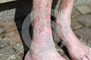 Leg of an old person with circulatory problems