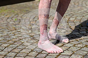 Leg of an old person with circulatory problems photo