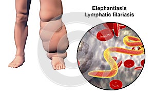 Leg of a person with elephantiasis, lymphatic filariasis