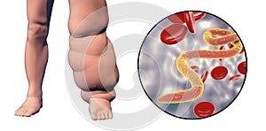 Leg of a person with elephantiasis, lymphatic filariasis