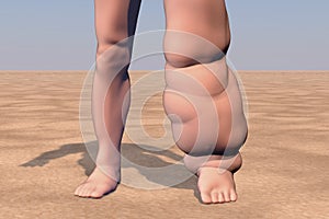 Leg of a person with elephantiasis, lymphatic filariasis photo