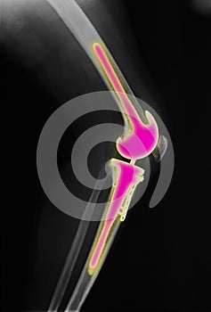 Leg x-ray, 46 year old female, knee replacement