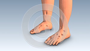 Leg swelling or lower limb edema