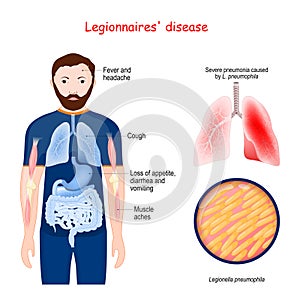 Legionnaires` disease. atypical pneumonia caused by bacteria Legionella photo