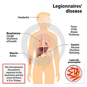 Legionnaires disease or legionellosis