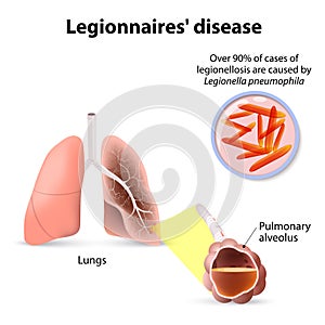 Legionnaires disease or legionellosis, Legion fever is a form o photo