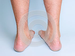 Legs of a man with a pronounced flat feet. Rear view.