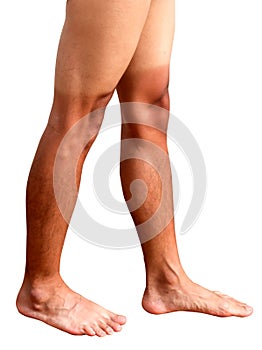 Legs of man sunburned