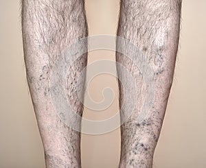 Legs of a man with varicose veins and capillaries