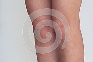 Legs with permanent oval birthmark