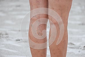 Legs of women, scars and varicose veins. photo