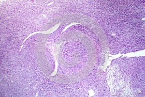 Leiomyosarcoma, light micrograph photo