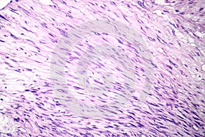 Leiomyosarcoma, light micrograph photo