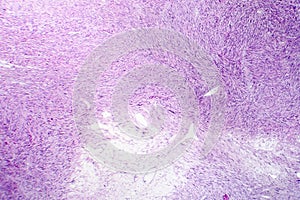 Leiomyosarcoma, a malignant cancerous smooth muscle tumor