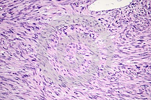 Leiomyosarcoma, a malignant cancerous smooth muscle tumor