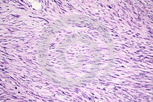 Leiomyosarcoma, a malignant cancerous smooth muscle tumor photo