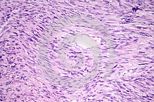 Leiomyosarcoma, a malignant cancerous smooth muscle tumor photo