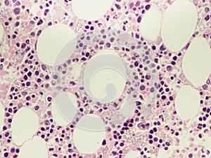 Leishmaniasis in bone marrow.