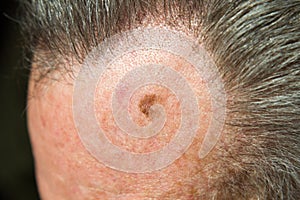 Lentigo maligna, melanoma in situ photo