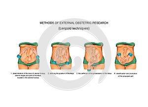 Leopold techniques in obstetrics