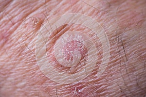 Lesion of actinic keratosis or sunspots man. Detail