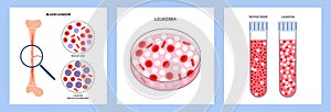 leukemia blood cancer photo