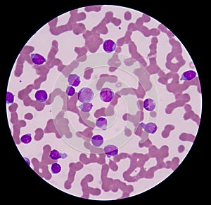 Leukemia blood picture.