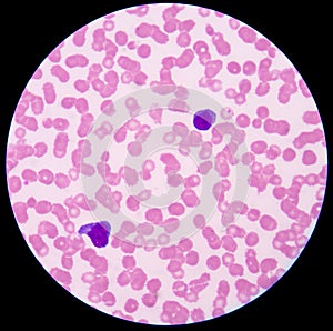 Leukemia blood picture.