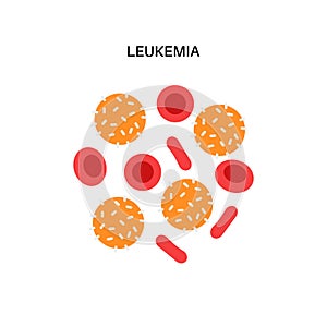 Leukemia cancer disease photo